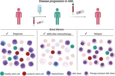 MRD Tailored Therapy in AML: What We Have Learned So Far